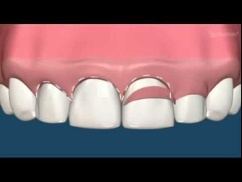Phẫu thuật làm dài thân răng hàm